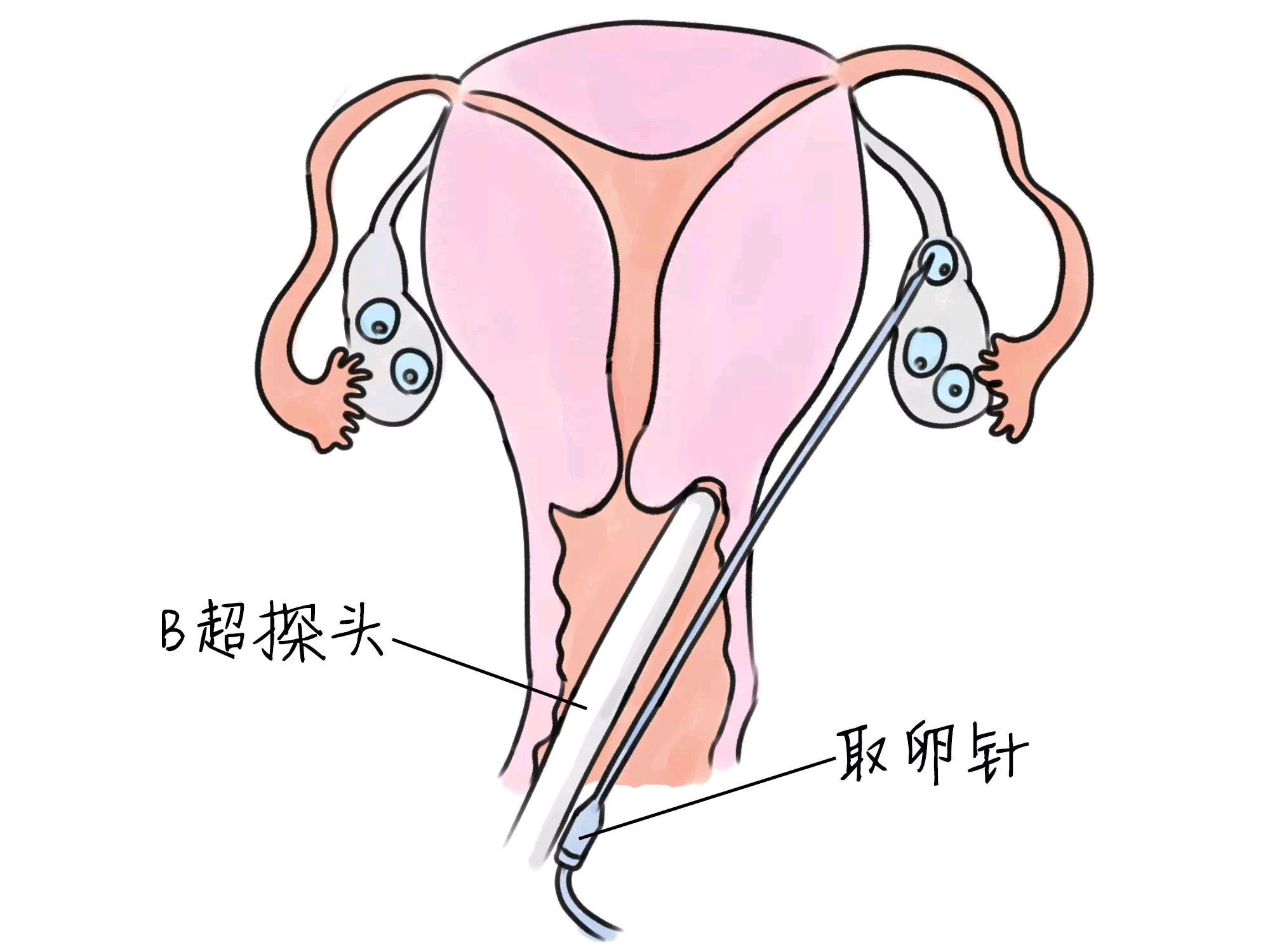 嘉兴捐卵公司