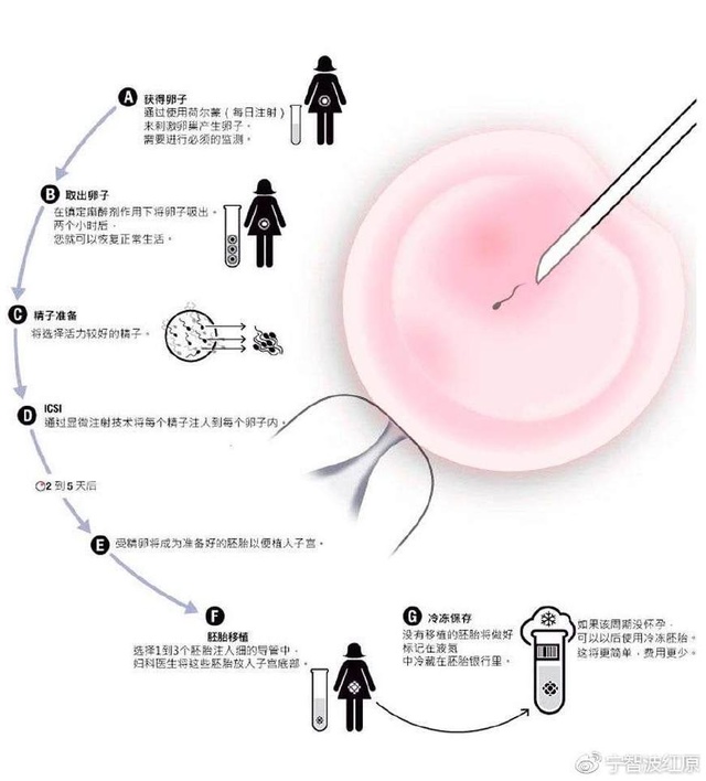 取卵费用