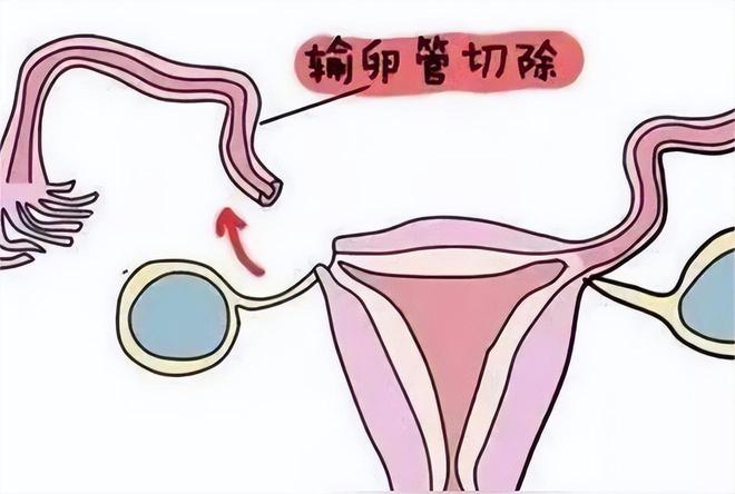 捐卵盲捐价格