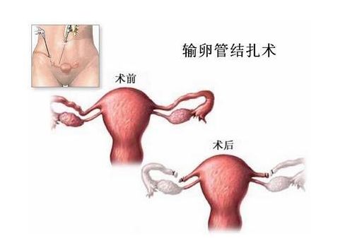 长沙捐卵试管中心医院